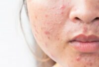 Cara Mencegah Jerawat Hormonal dengan Rutin Harian