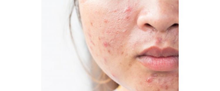 Cara Mencegah Jerawat Hormonal dengan Rutin Harian